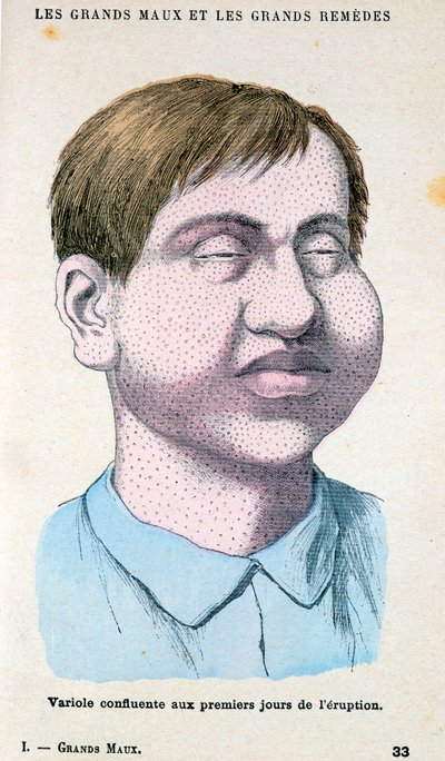 Smittkoppsoffer, c1890 av Unbekannt