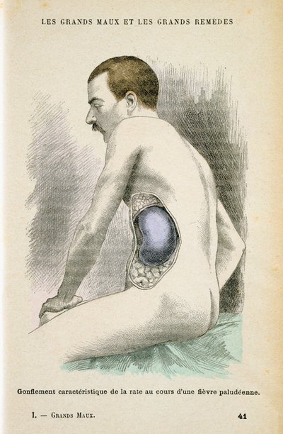 Typisk förstorad mjälte hos en malariapatient, c1890 av Unbekannt