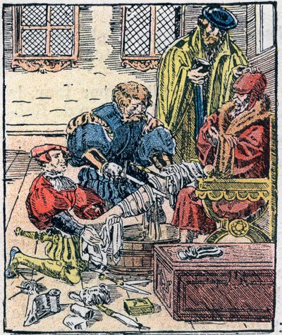 Amputation av ett ben på 1500-talet. av Unknown artist
