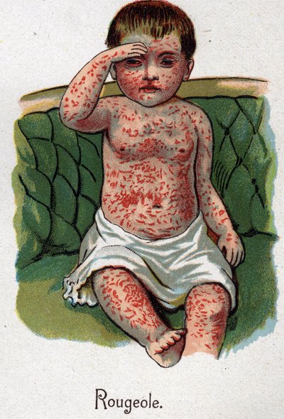 Barnsjukdomar: Mässling. I ”Den nya naturmedicinen”” av F.E. Bilz. av Unknown artist