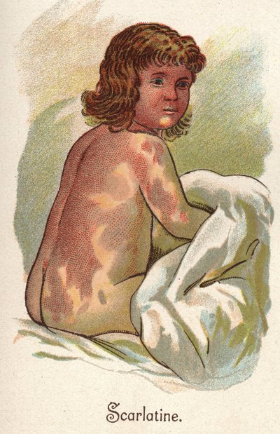 Barns sjukdomar: Scharlakansfeber. I ”The new natural medicine”” av F.E. Bilz. av Unknown artist
