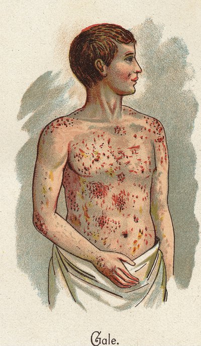 Barns sjukdomar: Skabben. I ”The new natural medicine”” av F.E. Bilz. av Unknown artist