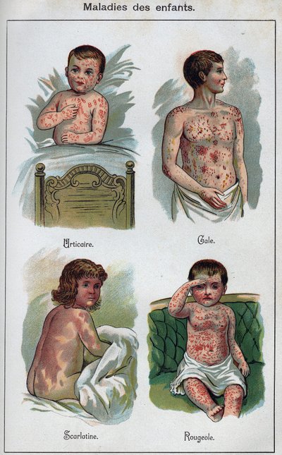 Sjukdomar hos barn: Nässelutslag, mässling, skabb, scharlakansfeber. I ”The new natural medicine”” av F.E. Bilz. av Unknown artist