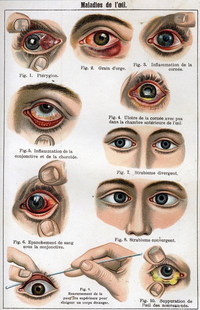 Sjukdomar i ögat. "Den nya naturmedicinen" av F.E. Bilz. av Unknown artist