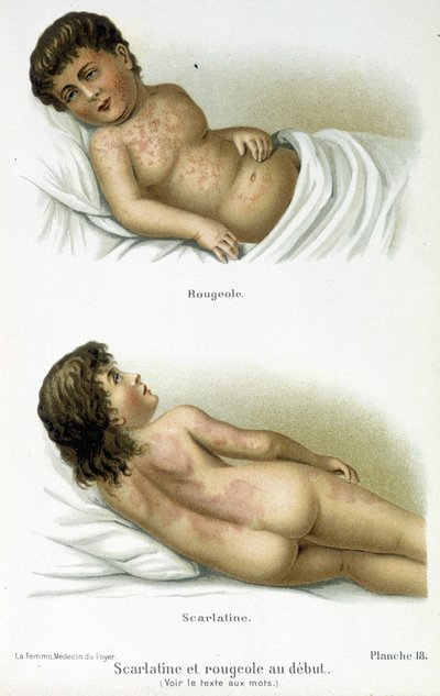 Scharlakansfeber och mässling - 1800-talet av Unknown artist