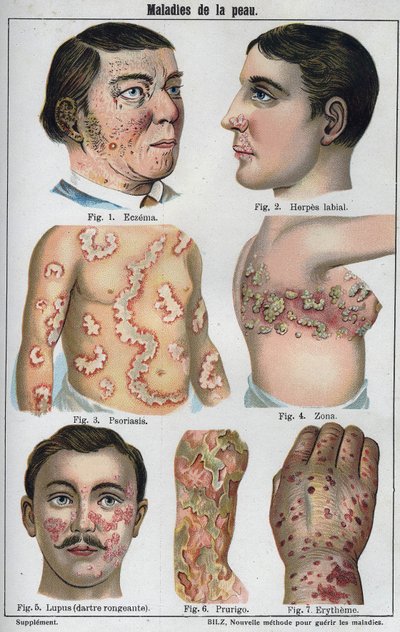 Hudsjukdomar: Eksem, labial herpes, psoriasis, bältros, lapus (ruttnande darter), prurigo, erytem." Den nya naturliga medicinen”” av F.E. Bilz. av Unknown artist