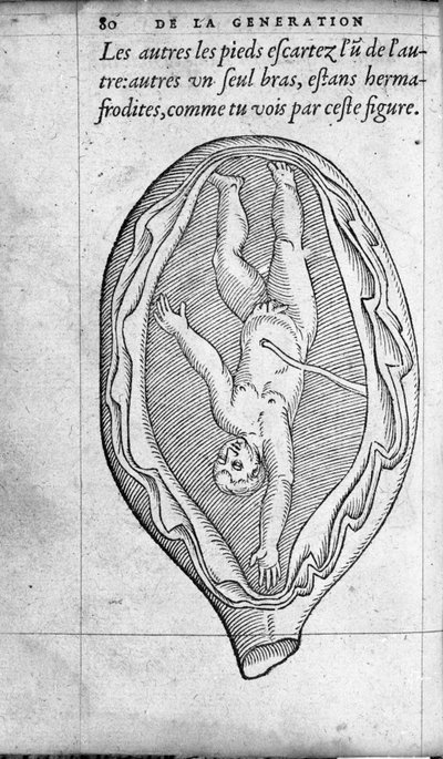 Fostrets position i livmodern under graviditeten. Gravyr från "" De la generation des enfants"" av den franska läkaren och kirurgen Ambroise Pare (1509-1590) 1500-talet av Unknown artist