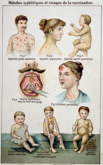Skylt som illustrerar de olika sovsalarna för syfilitiska sjukdomar och farorna med vaccination - i Bilz naturmedicin, sent 1800-tal. av Unknown artist