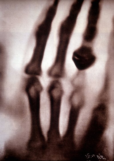 Röntgenstrålar (Rontgen) eller röntgenstrålar Första fotografiet: Röntgens hustrus hand. 1895-12-22. av Unknown artist