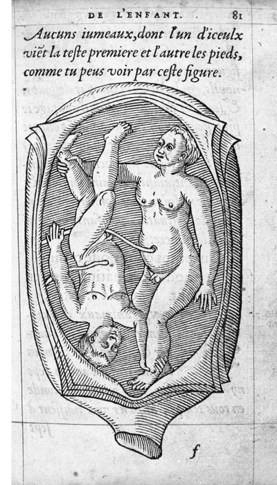 Fostrets position i livmodern under graviditeten. Gravyr från "" De la generation des enfants"" av den franska läkaren och kirurgen Ambroise Pare (1509-1590) 1500-talet av Unknown artist