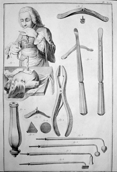 Trepanering av skallen, olika instrument (gravyr av Unknown artist
