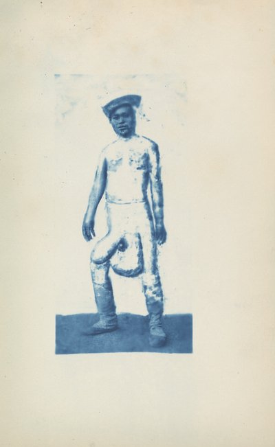 Elefantiasis,ca. 1870-talet (foto) av Unknown photographer