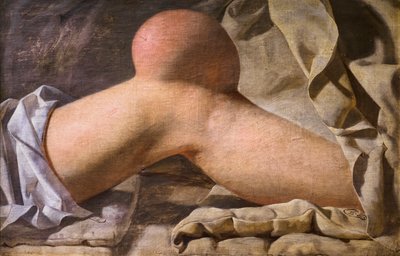 En svullnad i Regio Patellaris [knä] av Wilhelm Ferdinand Bendz