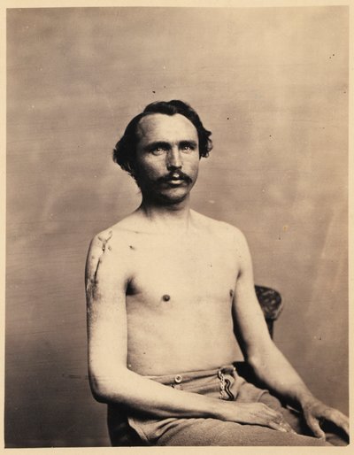 Menige Adolph Zirsse, lyckad mellanliggande excision av huvudet och två och en halv tum av skaftet på höger humerus, från den kirurgiska avdelningens fotografiska katalog av William Bell
