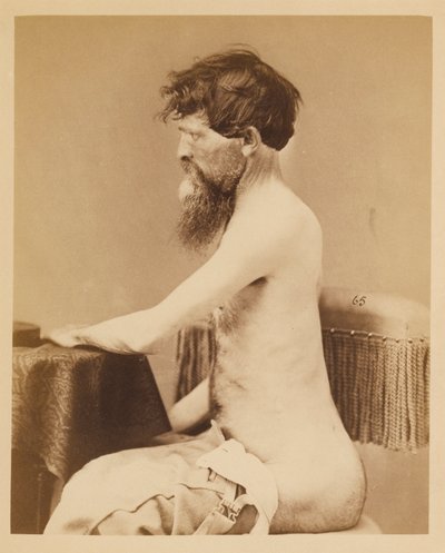 Menige John Bar, tillfrisknande efter en penetrerande sårskada i buken med fraktur på vänster Os Innominatum, från den kirurgiska avdelningens fotografiska katalog av William Bell