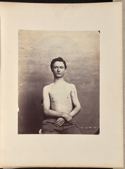 Återhämtning efter excision av huvudet på vänster humerus för skottfraktur av William H. Bell