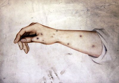 Studie av en underarm med hudtillstånd, ca 1850 (akvarell på papper) av William Lover