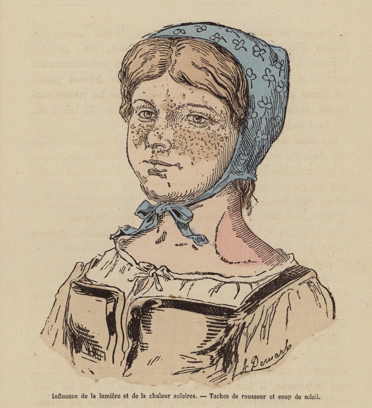 Kvinna med fräknar och solbränna orsakad av överdriven solexponering (kolorerad gravyr) av (after) French School
