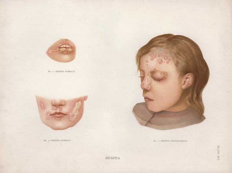 Hudsjukdomar: Herpes (färg litho) av English School