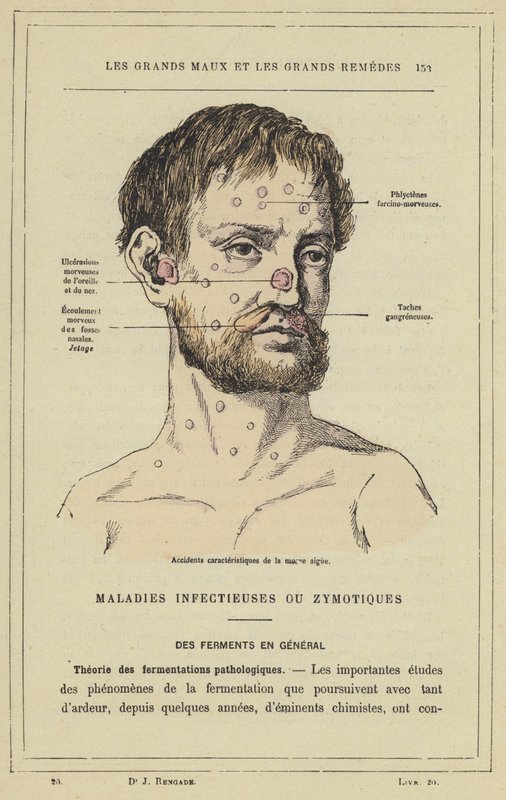 Karakteristiska slag av akut snot (färg litho) av French School