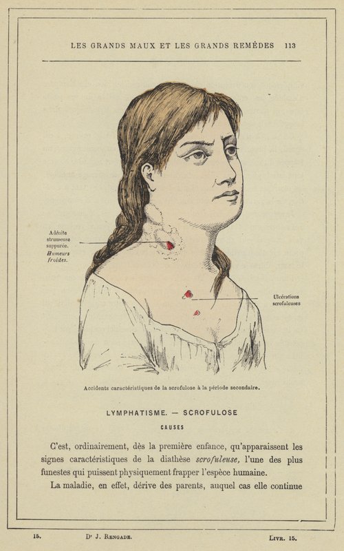 Karakteristiska olyckor av skrofulos i sekundärperioden (färg litho) av French School