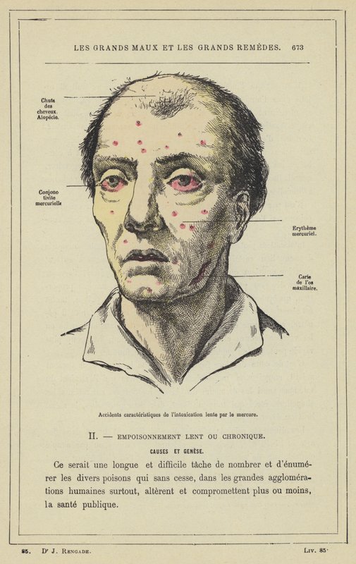 Karakteristiska olyckor med långsam kvicksilverförgiftning (färg litho) av French School