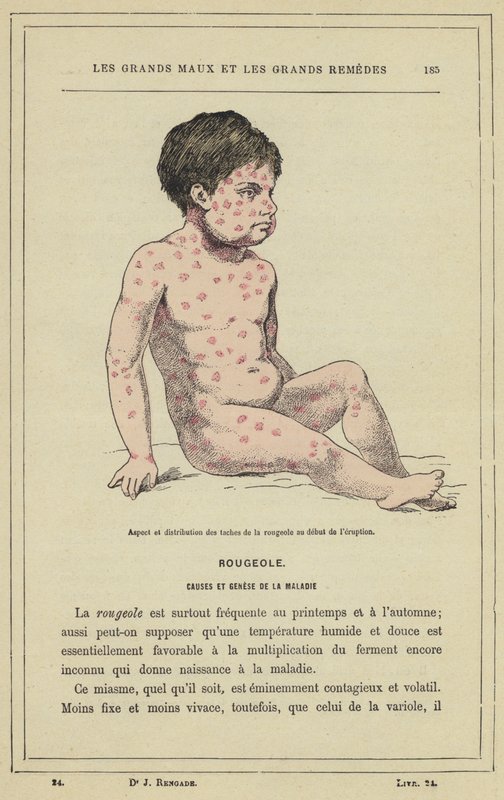 Utseende och fördelning av mässlingfläckar i början av utbrottet (färg litho) av French School