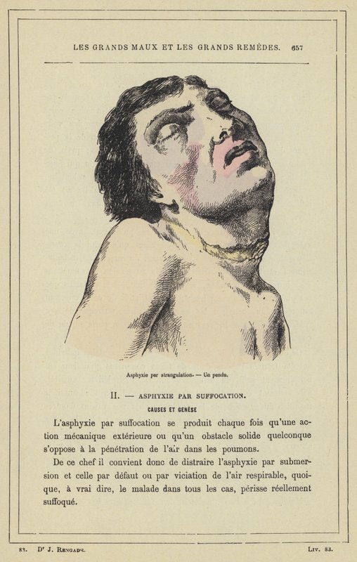Kvävning genom strypning, En hängd man (färg litho) av French School