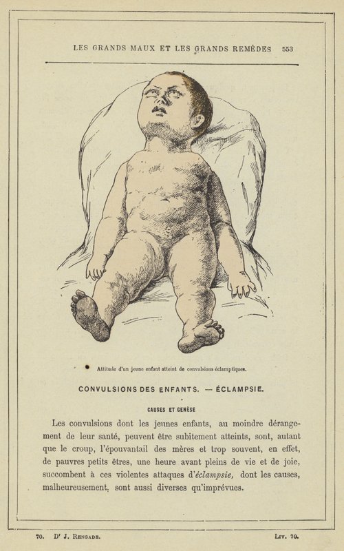 Attityd hos ett litet barn med eklamptiska kramper (färg litho) av French School