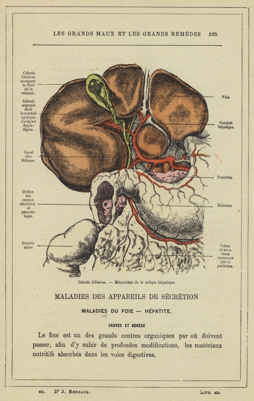 Gallsten, Mekanism av hepatisk kolik (färg litho) av French School