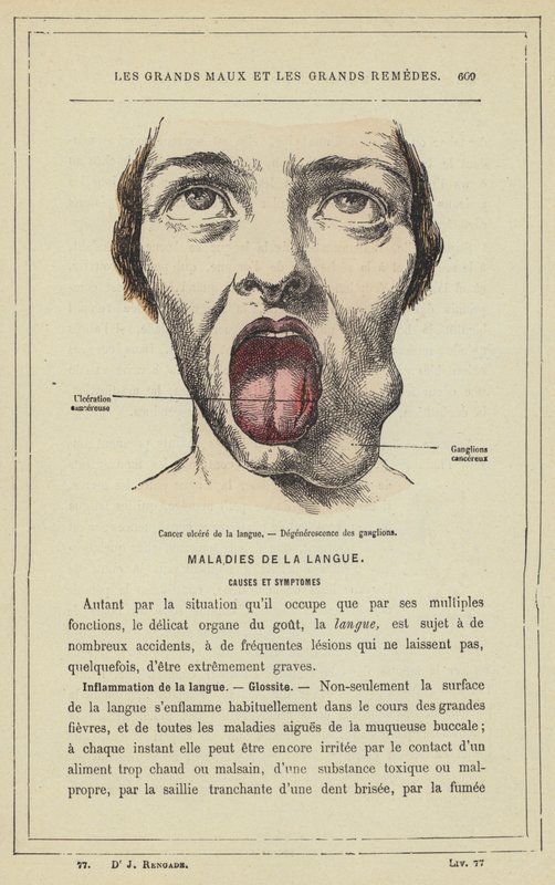 Cancer i tungsår, degeneration av lymfkörteln (färg litho) av French School