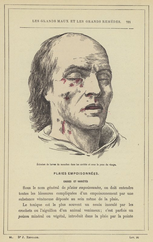 Kläckning av fluglarver i håligheterna och under huden i ansiktet (färg litho) av French School