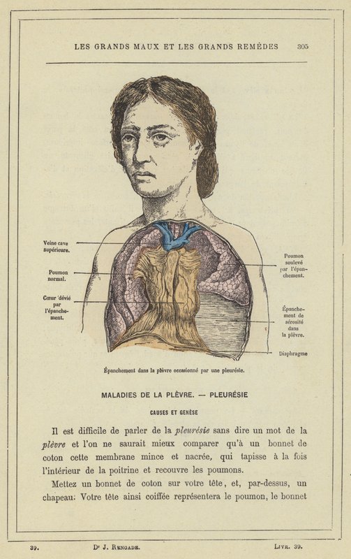 Effusion i lungsäcken orsakad av lungsäcksinflammation (färg litho) av French School