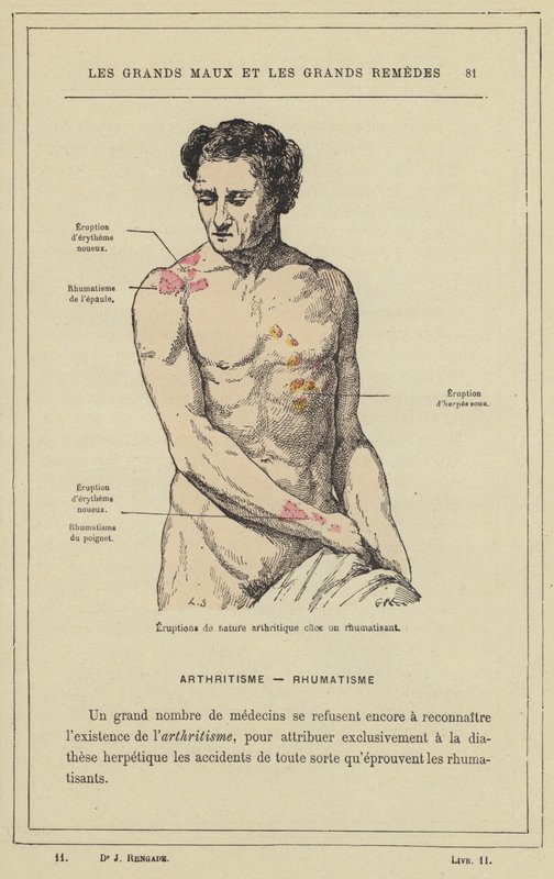 Utbrott av artritisk karaktär hos en reumatisk patient (färg litho) av French School