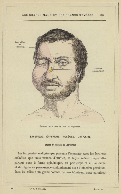 Progressiv erysipelas i ansiktet (färg litho) av French School