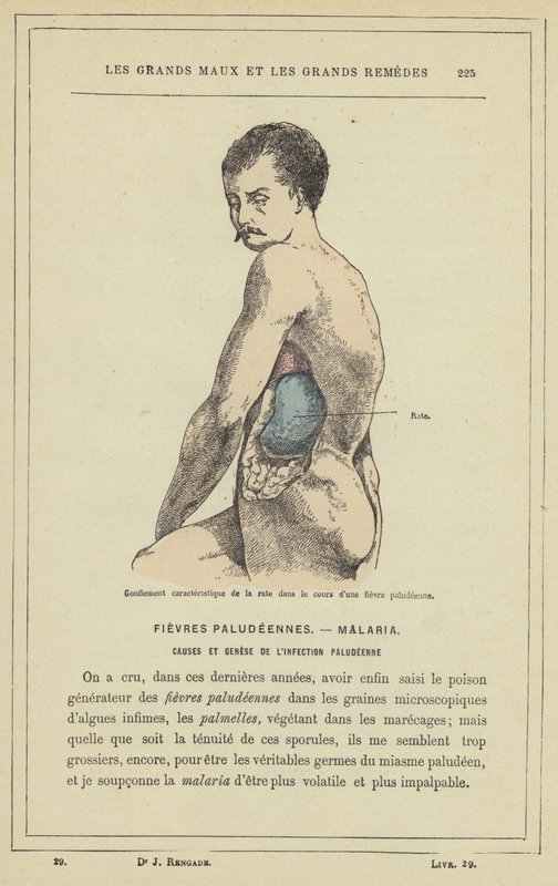 Karakteristisk svullnad av mjälten under malariafeber (färg litho) av French School