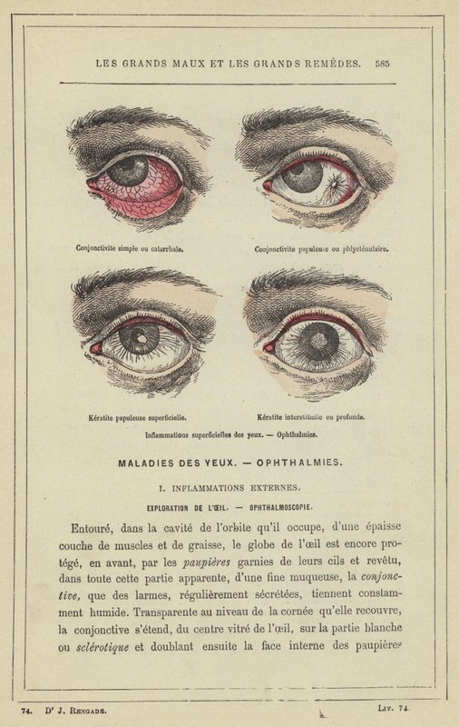 Ytliga ögoninflammationer, Oftalmi (färg litho) av French School