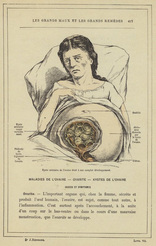 Areolär cysta i höger äggstock i full utveckling (färg litho) av French School