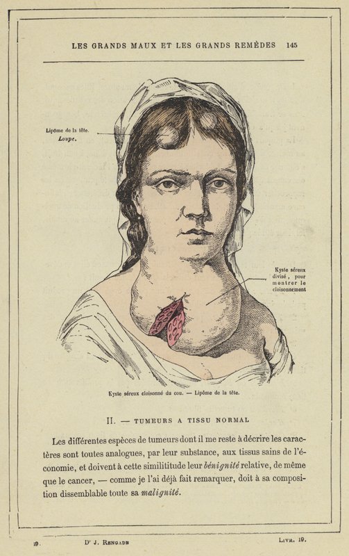 Cloisonne serös cysta i halsen, Lipom i huvudet (färg litho) av French School