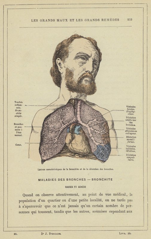 Lesioner karakteristiska för bronkit och bronkial dilatation (färg litho) av French School