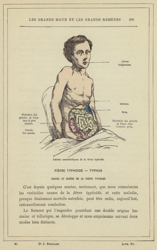 Karakteristiska lesioner av tyfoidfeber (färg litho) av French School