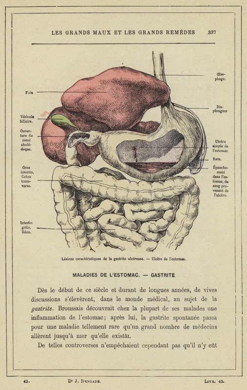 Karakteristiska lesioner av ulcerös gastrit, magsår (färg litho) av French School