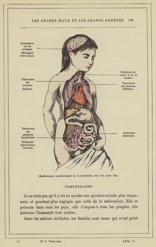 Karakteristiska manifestationer av tuberkulos hos en ung flicka (färg litho) av French School