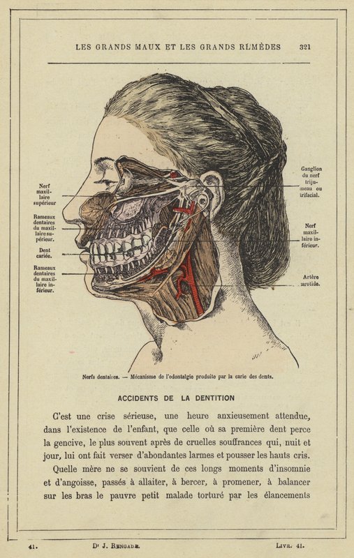 Dentala nerver, Mekanism för odontalgi som orsakas av karies (färg litho) av French School