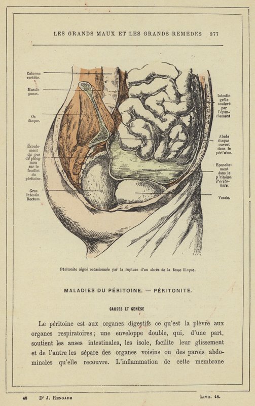 Akut peritonit orsakad av bristning av fossa iliacabscess (färg litho) av French School