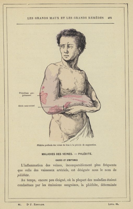 Djup flebit i armens vener vid suppurationsperioden (färg litho) av French School