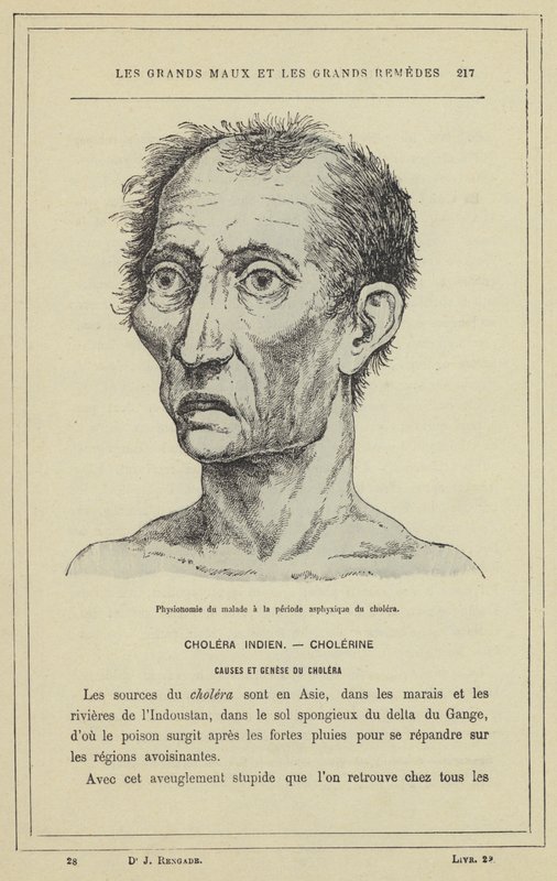 Fysiognomi av patienten under asfyxiperioden av kolera (färg litho) av French School