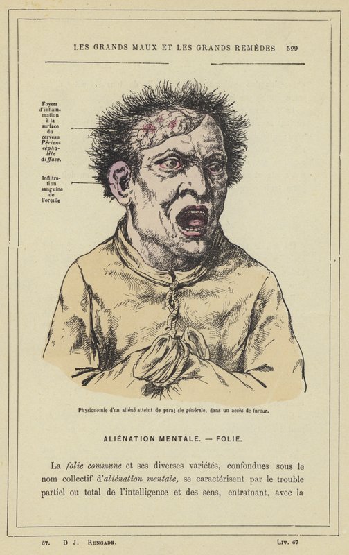 Fysiognomi av en utomjording som drabbats av paral sie generale, i ett raseri (färg litho) av French School