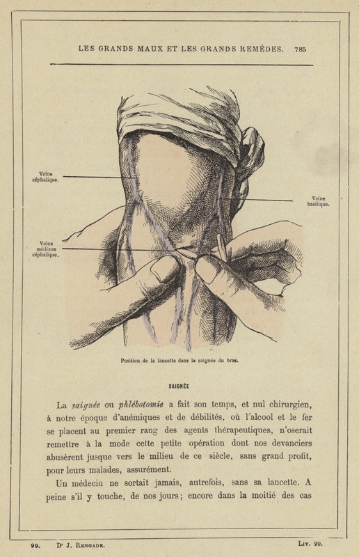 Lansettens position i armblödningen (färg litho) av French School