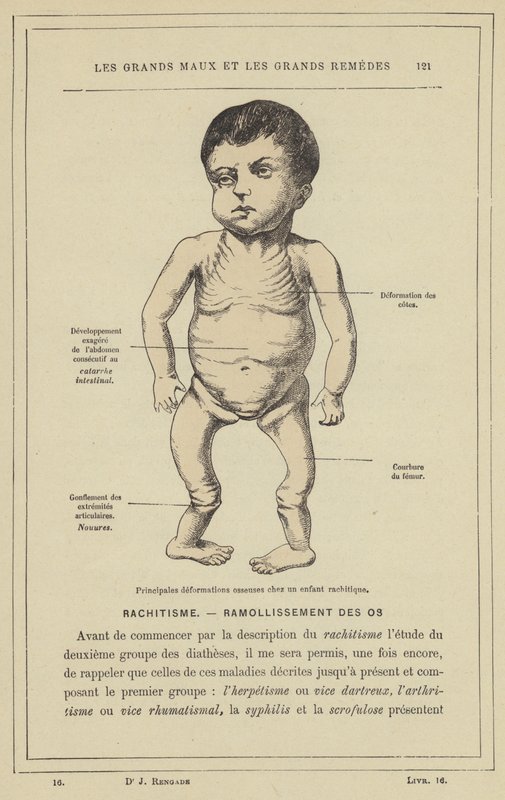 Huvudsakliga bendeformationer hos ett barn med rakitis (färg litho) av French School